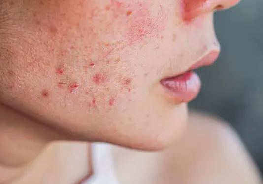 How a Dermatologist Thinks About (and Treats) Acne Scars (Part 2)